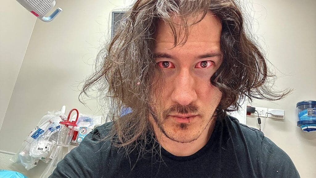 Markiplier looks at the camera with heavily inflamed sclera.